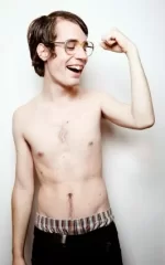 Tennis elbow, urgent advice needed